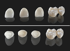 Cirkon fogpotlasok 1